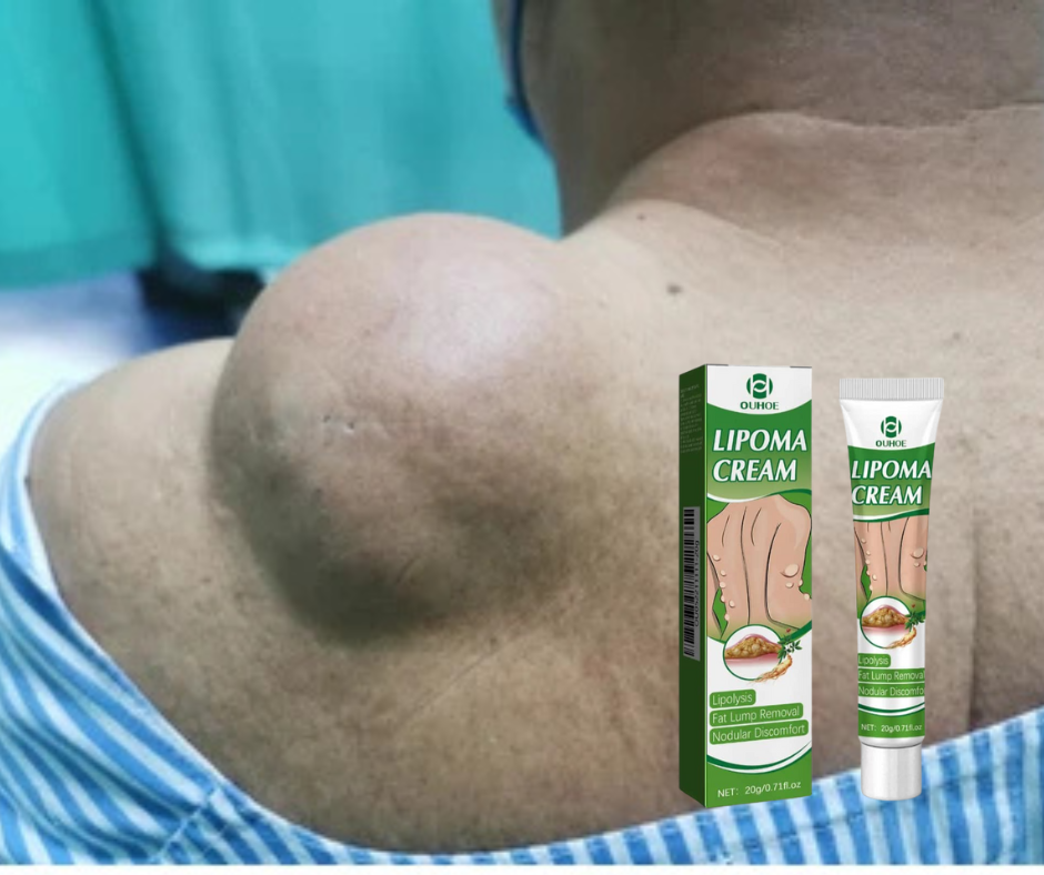 DITES ADIEU AUX LIPOMES, AUX KYSTES ET A TOUT TYPES DE BOULES SUR LE CORPS SANS CHIRURGIE EN QUELQUES JOURS AVEC NOTRE SOLUTION NATURELLE REVOLUTIONNAIRE