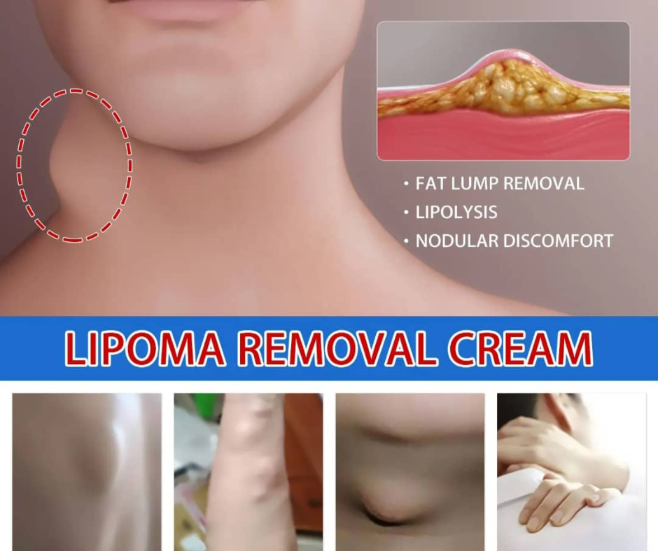 DITES ADIEU AUX LIPOMES, AUX KYSTES ET A TOUT TYPES DE BOULES SUR LE CORPS SANS CHIRURGIE EN QUELQUES JOURS AVEC NOTRE SOLUTION NATURELLE REVOLUTIONNAIRE