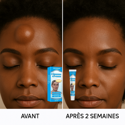 DITES ADIEUX AUX LIPOMES KYSTES GONFLEMENTS ET TOUT TYPE DE BOULE SUR LE CORPSS EN QUELQUES JOURS SANS CHIRURGIE AVEC NOTRE SOLUTION NATURELLE REOLUTIONNAIRE